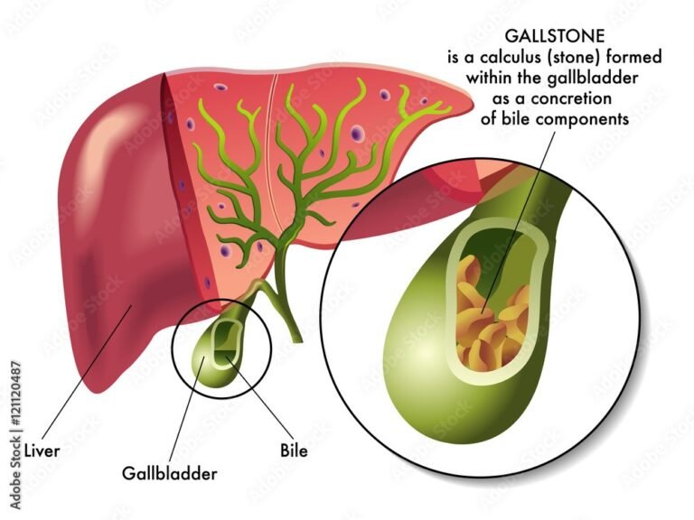 1.Gallbladder stones: It’s Causes, Symptoms & Treatment